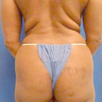 Flank-Lower Back Liposuction Gallery - Patient 3718940 - Image 1