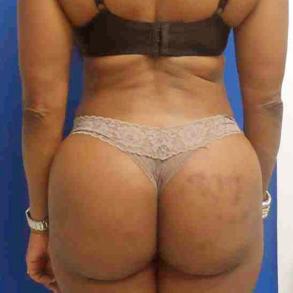 Flank-Lower Back Liposuction Gallery - Patient 3718940 - Image 2