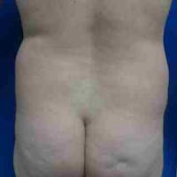Flank-Lower Back Liposuction Gallery - Patient 3718960 - Image 1