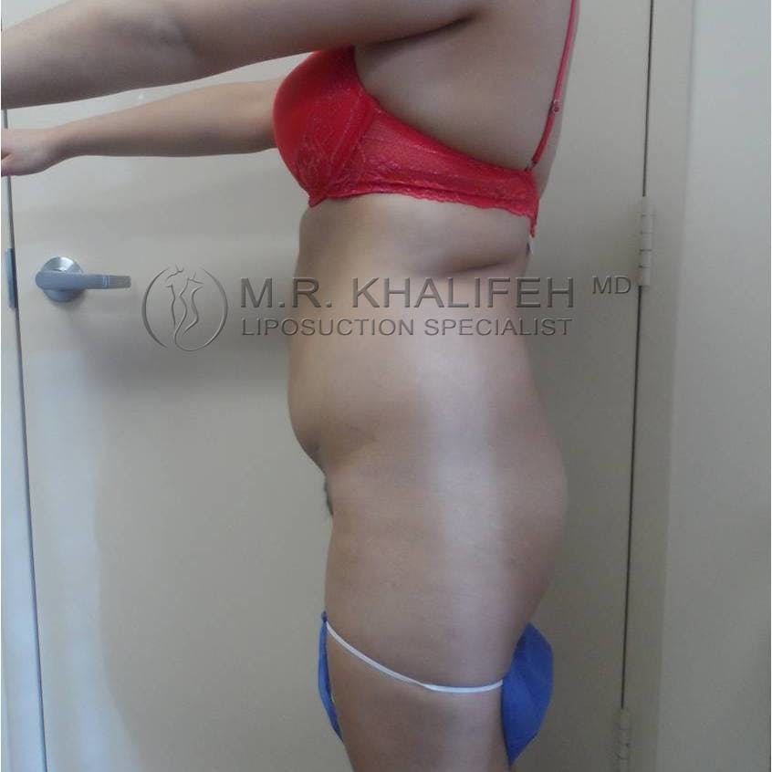 Flank-Lower Back Liposuction Gallery - Patient 3719001 - Image 1