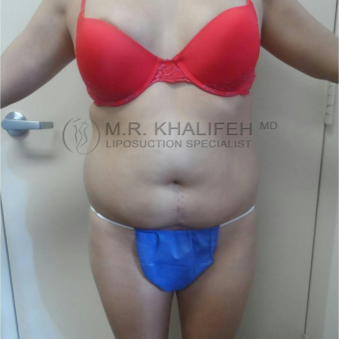 Flank-Lower Back Liposuction Gallery - Patient 3719001 - Image 7