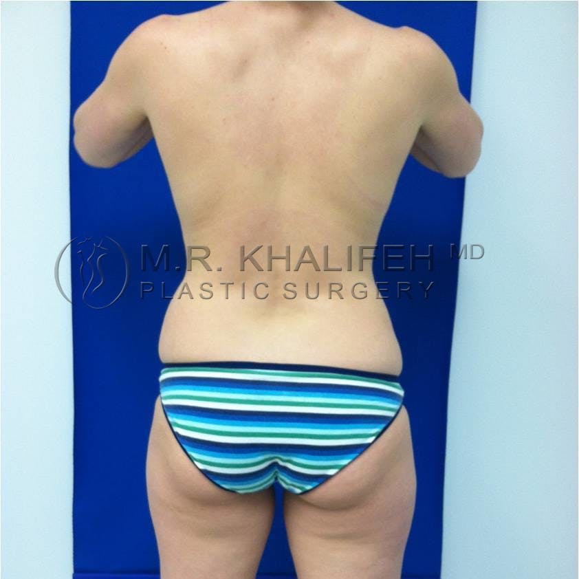 Flank-Lower Back Liposuction Gallery - Patient 3719100 - Image 1