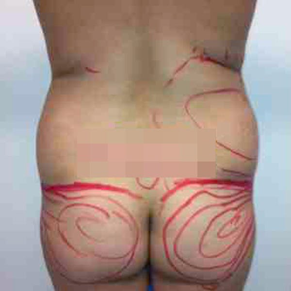 Flank-Lower Back Liposuction Gallery - Patient 3719130 - Image 1