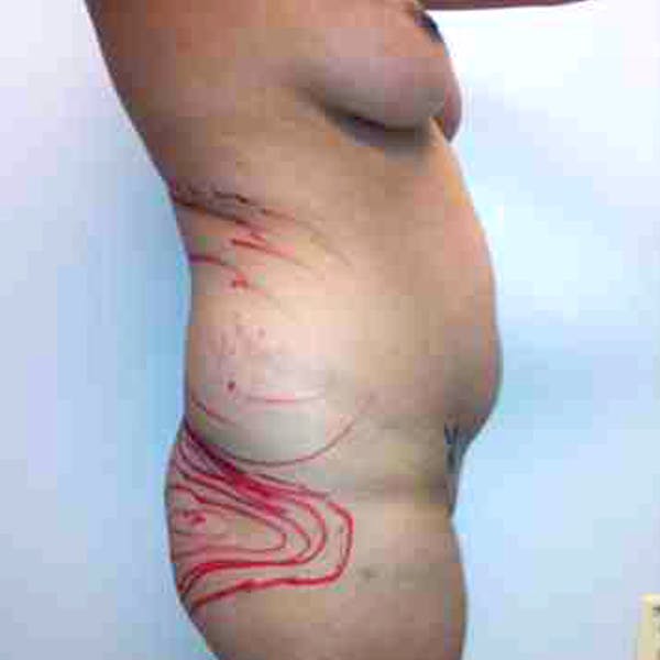 Flank-Lower Back Liposuction Gallery - Patient 3719130 - Image 5