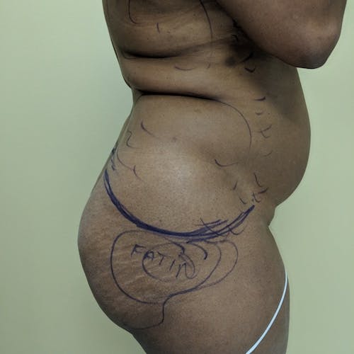 Flank-Lower Back Liposuction Gallery - Patient 3719147 - Image 3