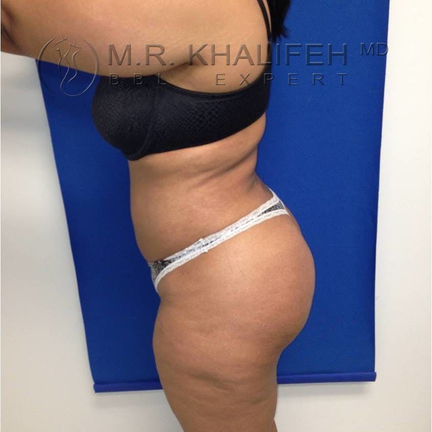 Flank-Lower Back Liposuction Gallery - Patient 3719190 - Image 4