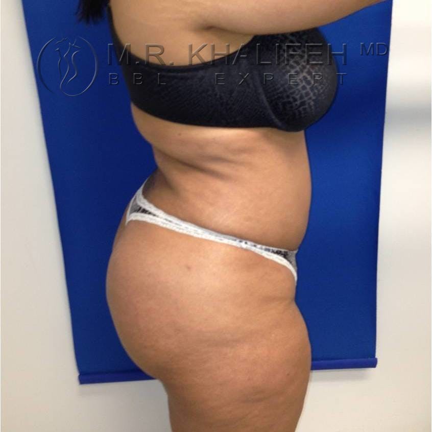 Flank-Lower Back Liposuction Gallery - Patient 3719190 - Image 6