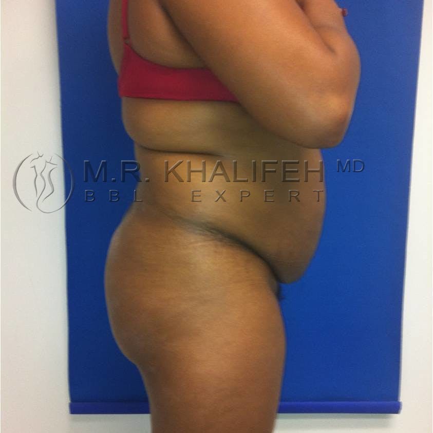 Flank-Lower Back Liposuction Gallery - Patient 3719224 - Image 5