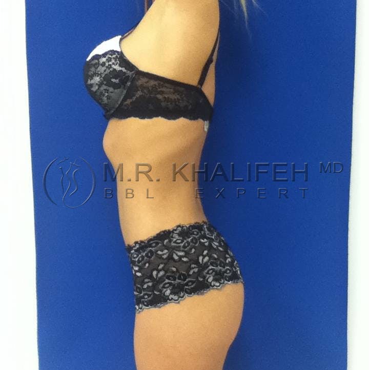 Flank-Lower Back Liposuction Gallery - Patient 3719272 - Image 6