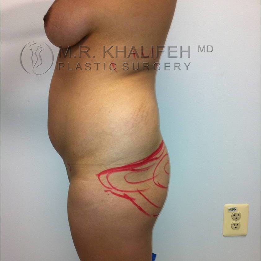 Flank-Lower Back Liposuction Gallery - Patient 3719308 - Image 3