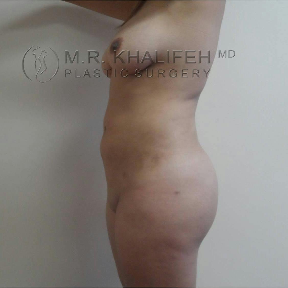 Flank-Lower Back Liposuction Gallery - Patient 3719308 - Image 4