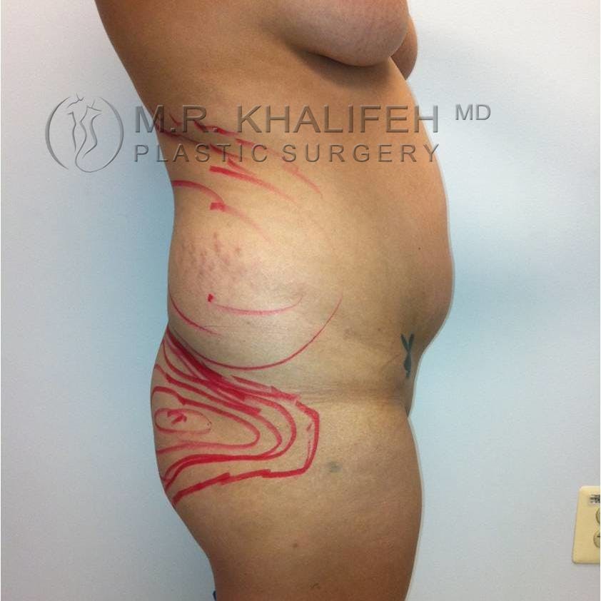 Flank-Lower Back Liposuction Gallery - Patient 3719308 - Image 5