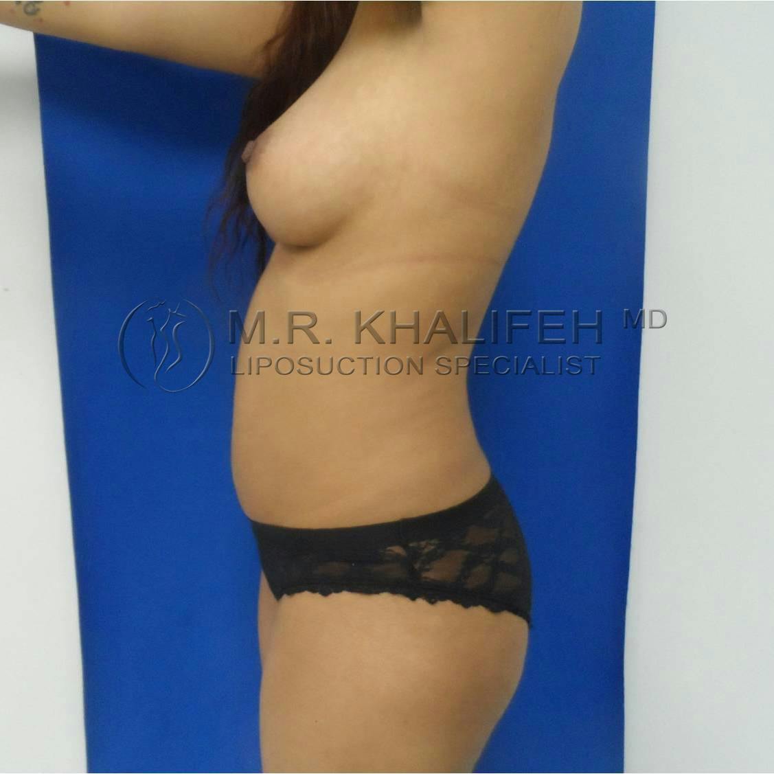 Flank-Lower Back Liposuction Gallery - Patient 3719350 - Image 7