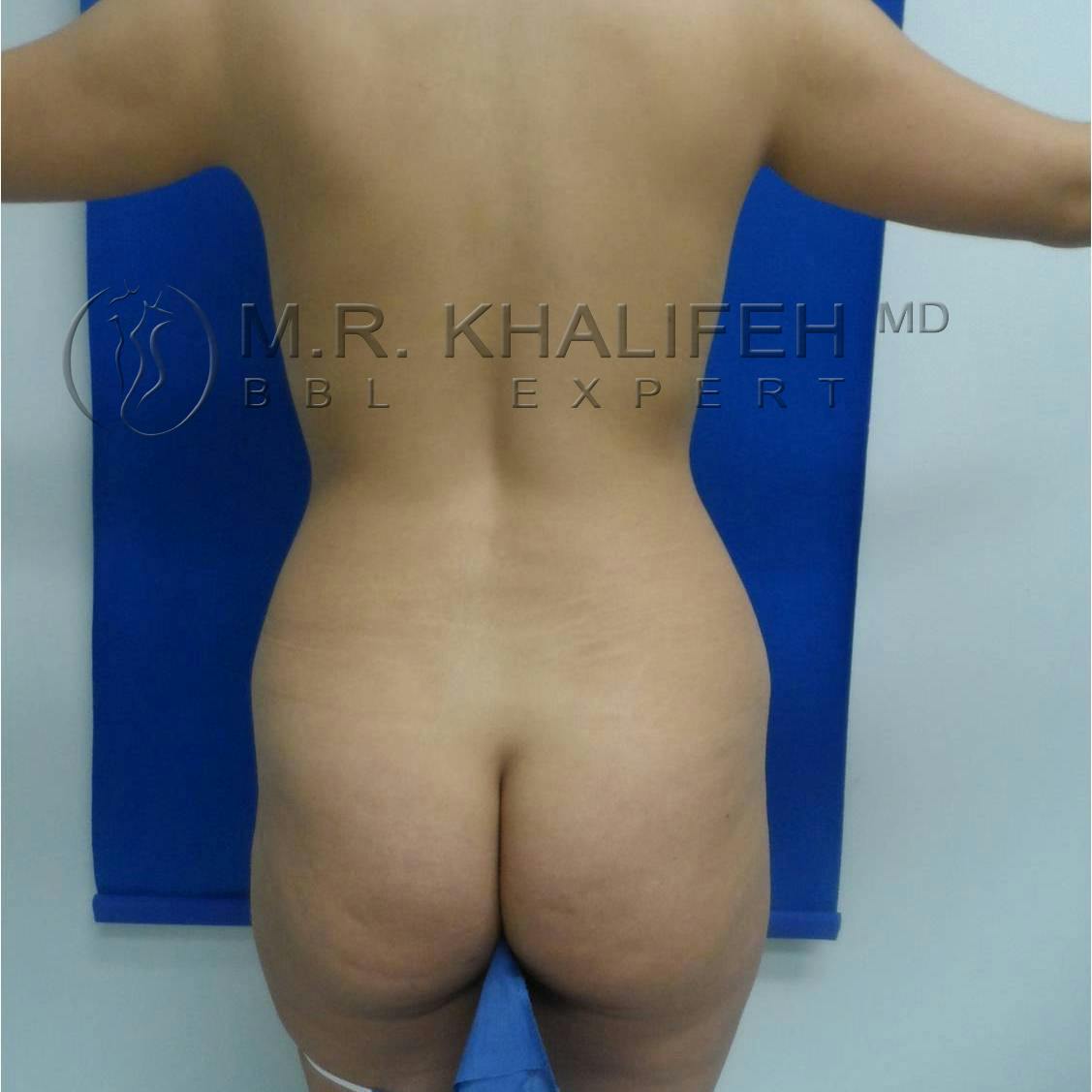 Flank-Lower Back Liposuction Gallery - Patient 3719503 - Image 1