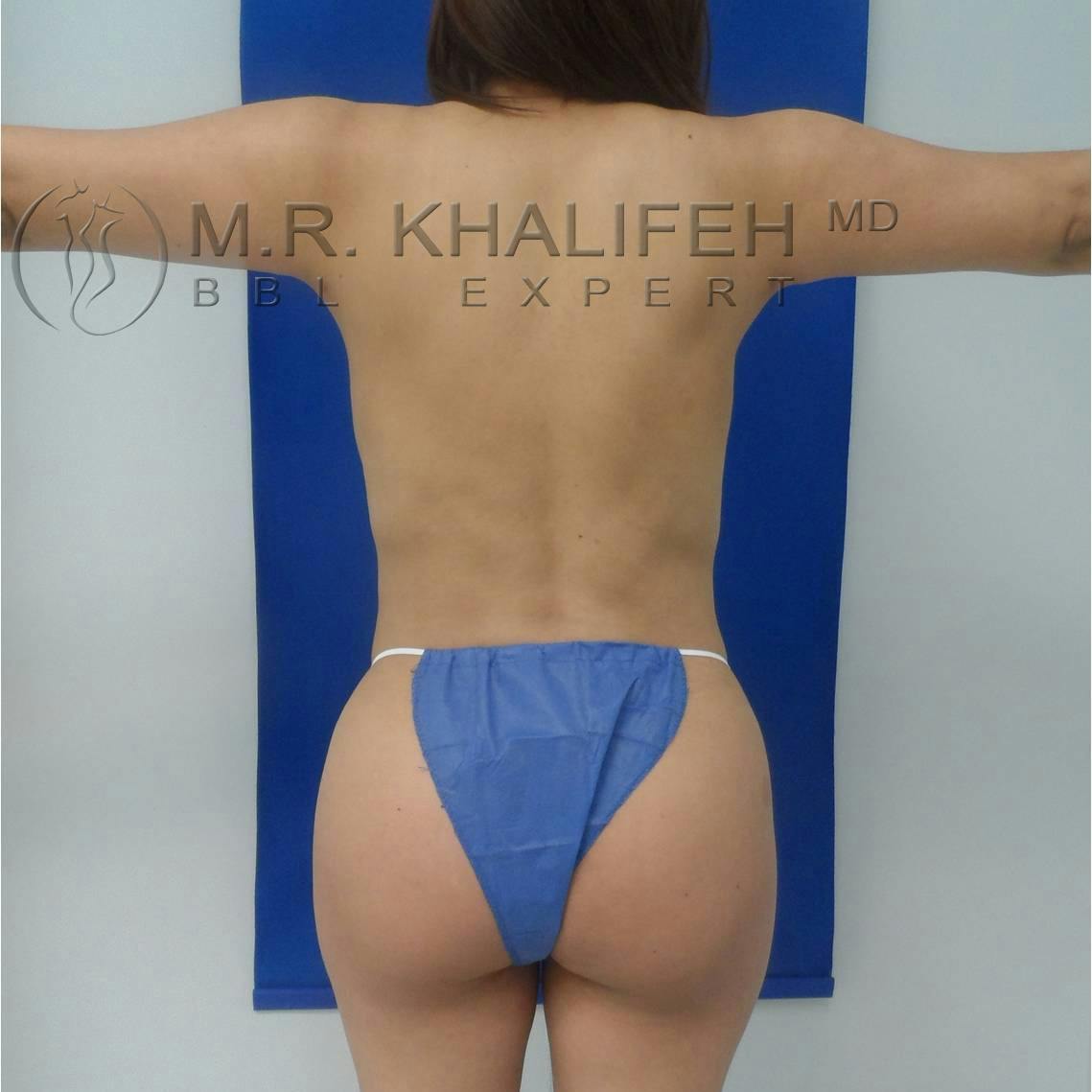 Flank-Lower Back Liposuction Gallery - Patient 3719561 - Image 2