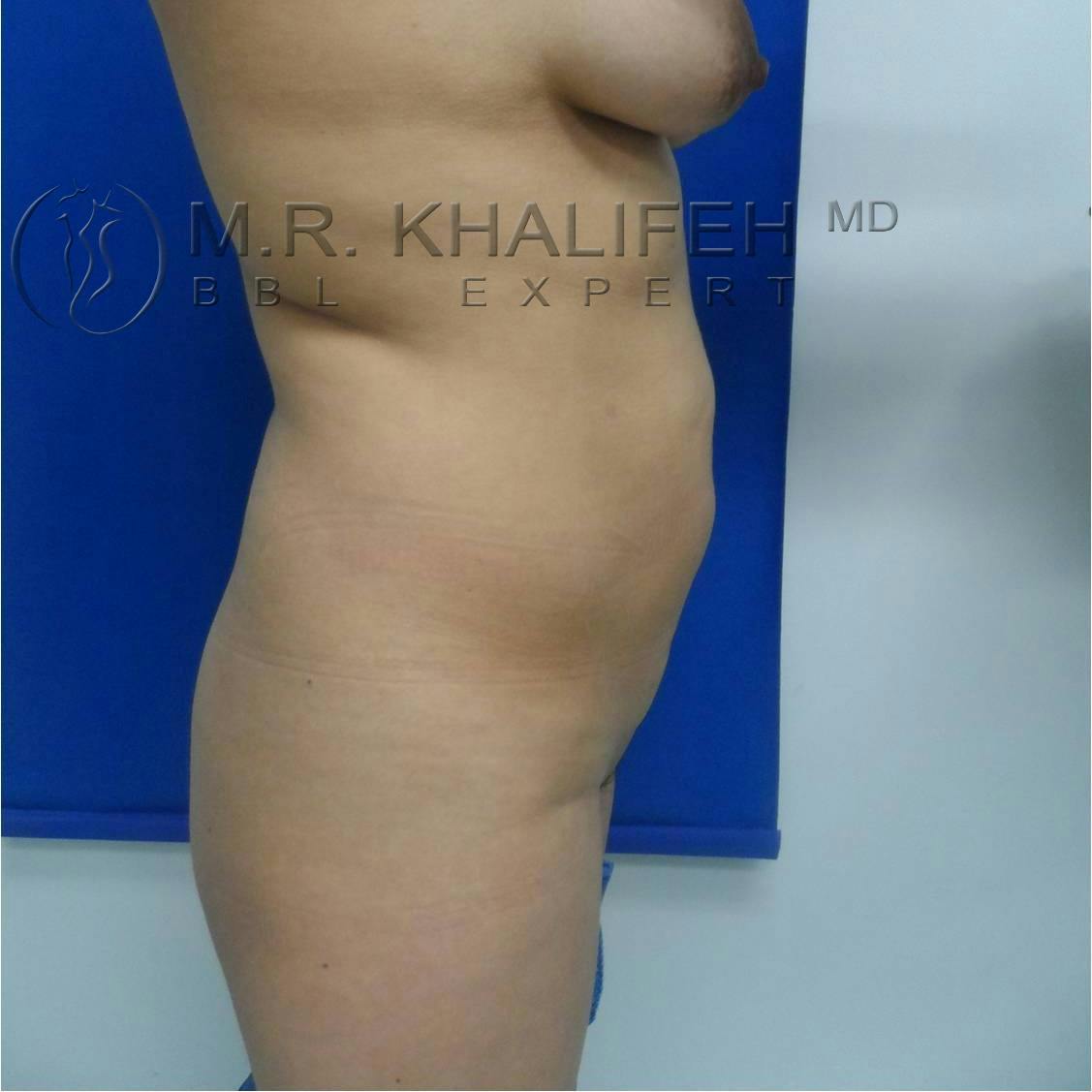 Flank-Lower Back Liposuction Gallery - Patient 3719561 - Image 5