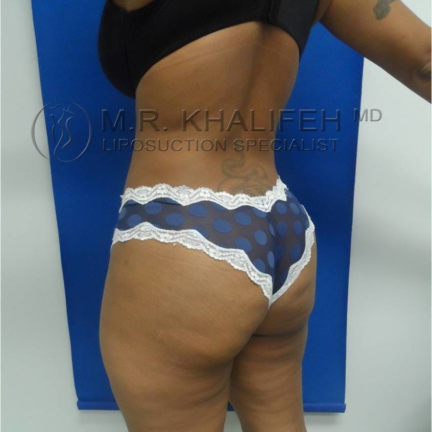 Flank-Lower Back Liposuction Gallery - Patient 3719653 - Image 4