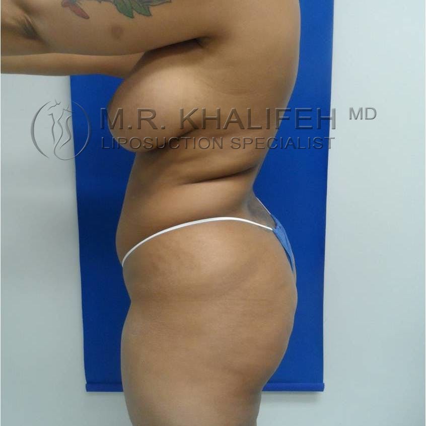 Flank-Lower Back Liposuction Gallery - Patient 3719653 - Image 3