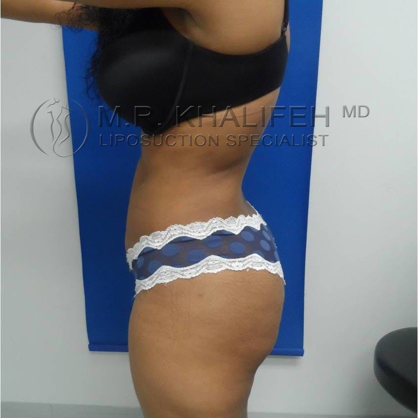 Flank-Lower Back Liposuction Gallery - Patient 3719653 - Image 6