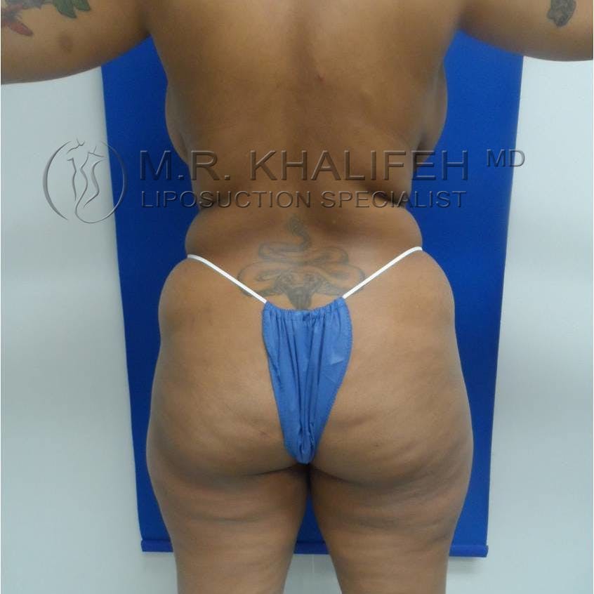 Flank-Lower Back Liposuction Gallery - Patient 3719653 - Image 7