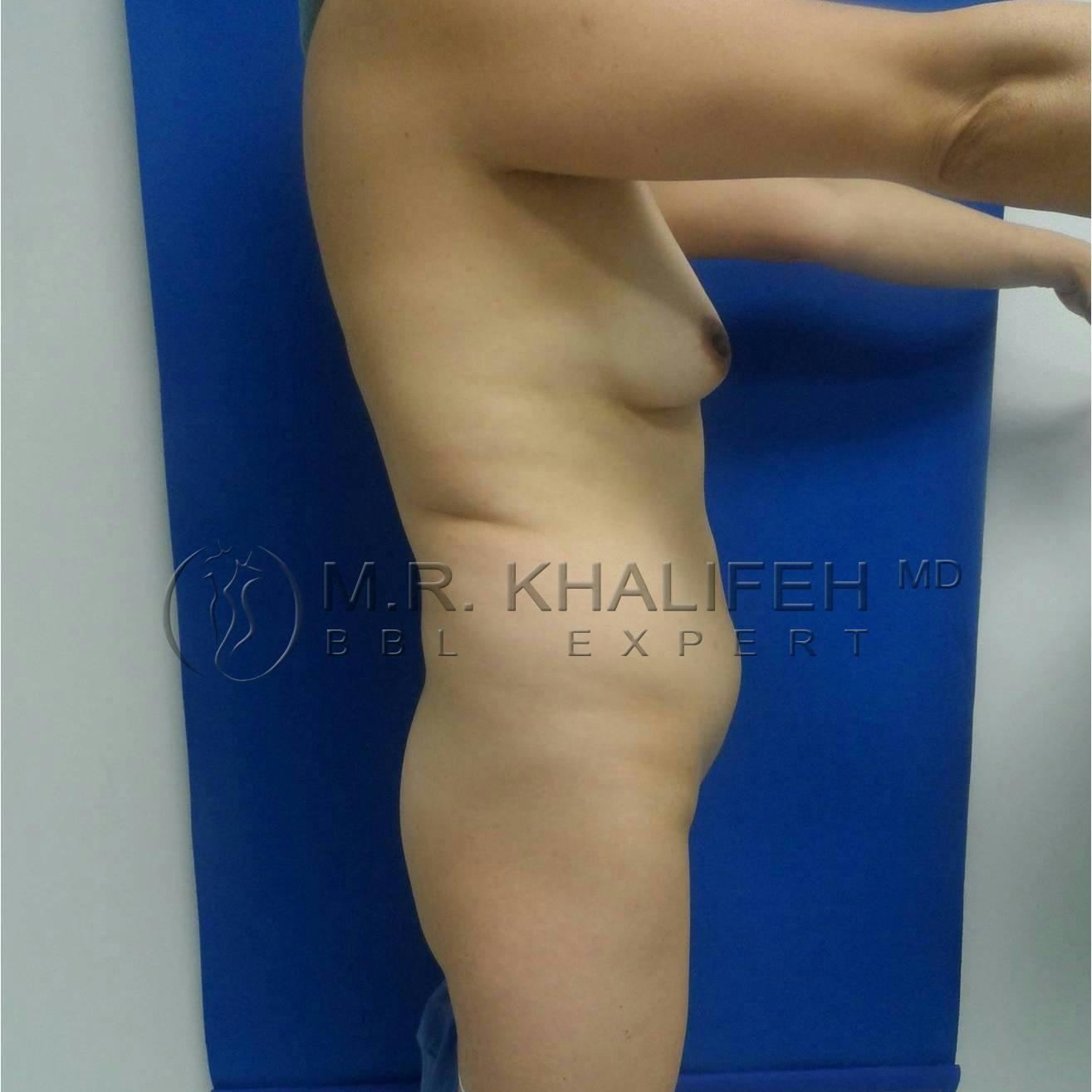 Flank-Lower Back Liposuction Gallery - Patient 3719676 - Image 5