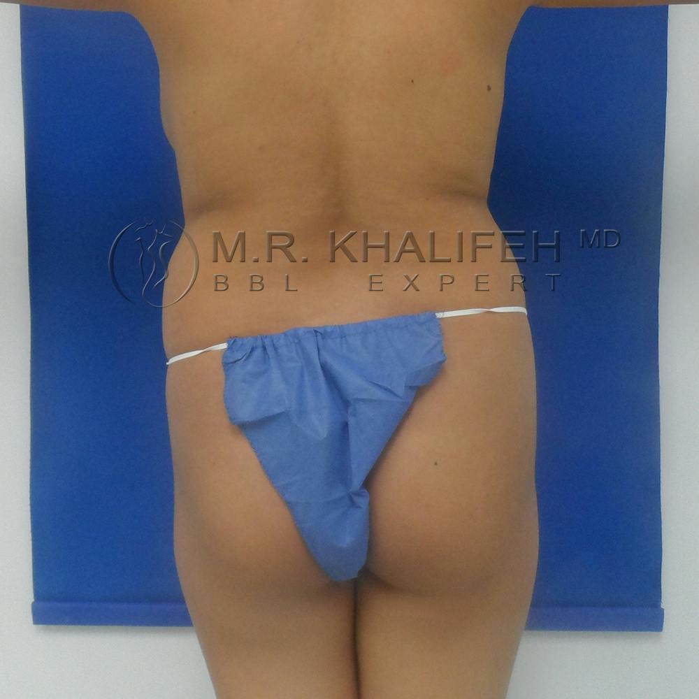 Flank-Lower Back Liposuction Gallery - Patient 3719722 - Image 1