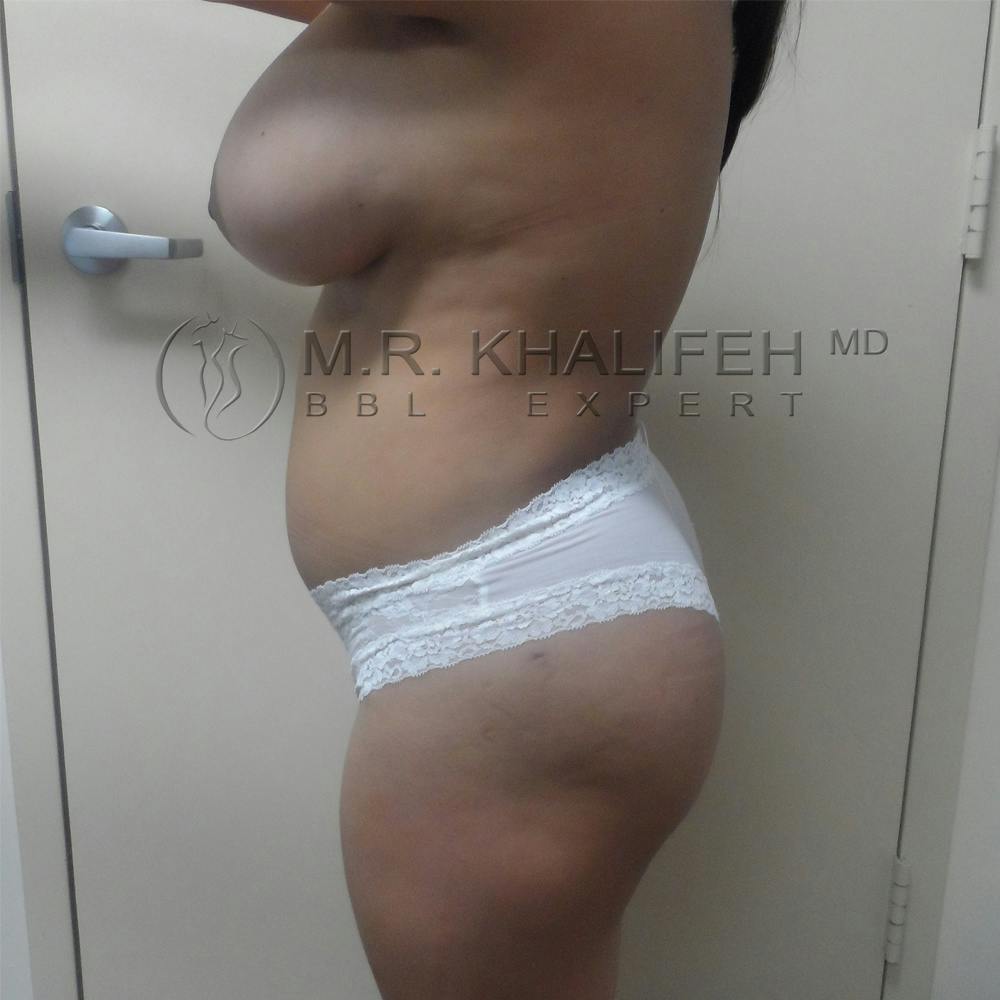 Flank-Lower Back Liposuction Gallery - Patient 3719722 - Image 8
