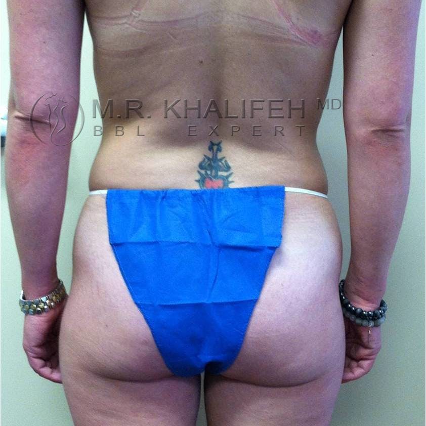 Flank-Lower Back Liposuction Gallery - Patient 3719773 - Image 1