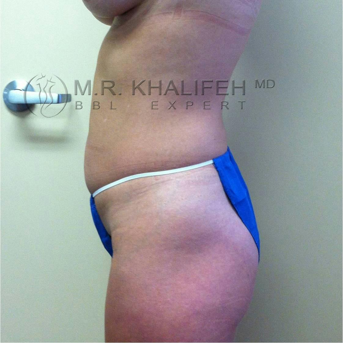 Flank-Lower Back Liposuction Gallery - Patient 3719773 - Image 5