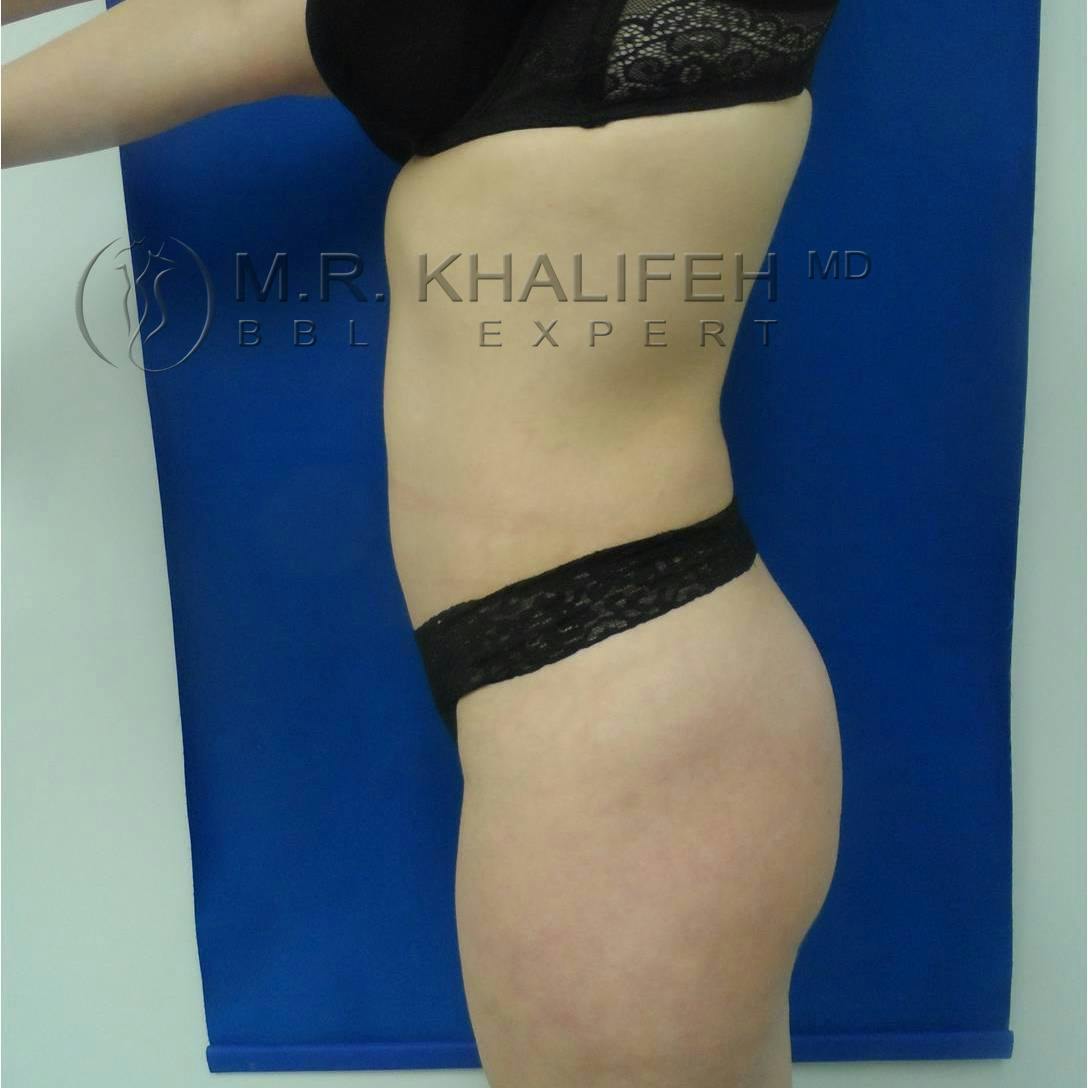 Flank-Lower Back Liposuction Gallery - Patient 3719773 - Image 6