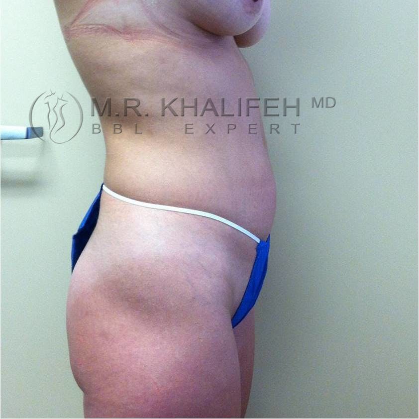 Flank-Lower Back Liposuction Gallery - Patient 3719773 - Image 7