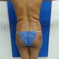 Flank-Lower Back Liposuction Gallery - Patient 3719882 - Image 1