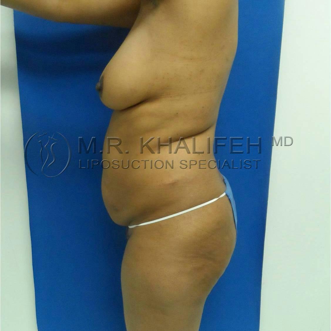 Flank-Lower Back Liposuction Gallery - Patient 3719882 - Image 7