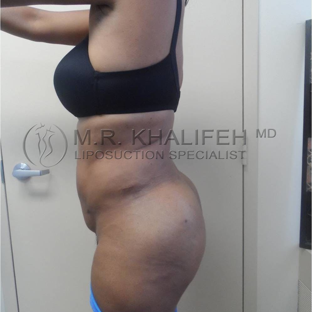 Flank-Lower Back Liposuction Gallery - Patient 3719882 - Image 8