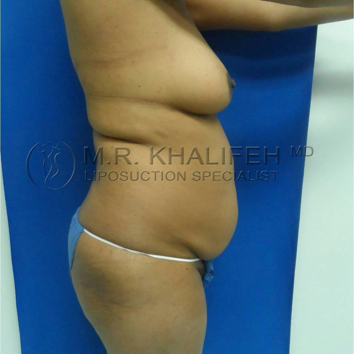 Flank-Lower Back Liposuction Gallery - Patient 3719882 - Image 9