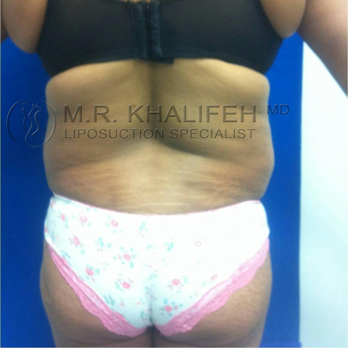 Flank-Lower Back Liposuction Gallery - Patient 3719930 - Image 1