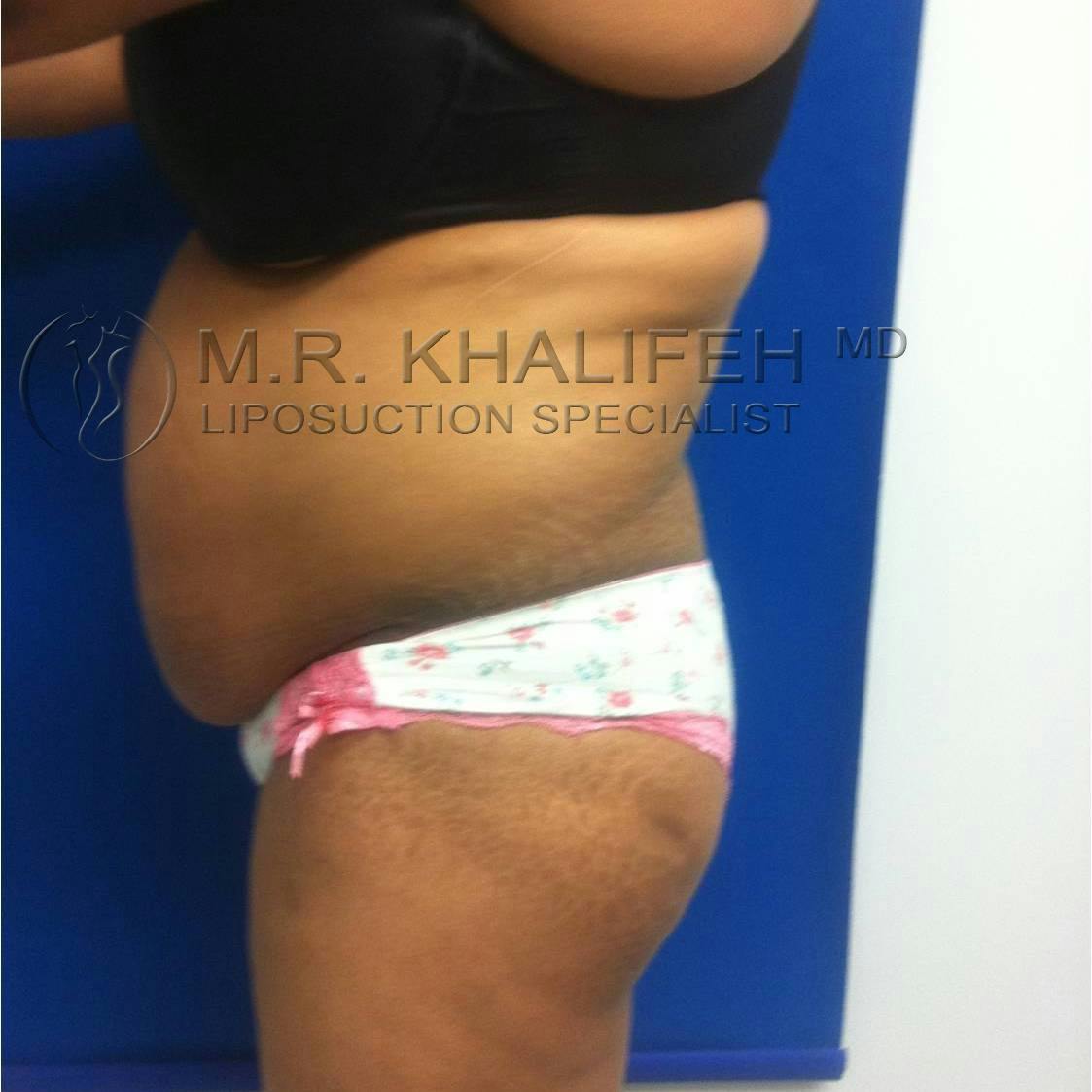 Flank-Lower Back Liposuction Gallery - Patient 3719930 - Image 3