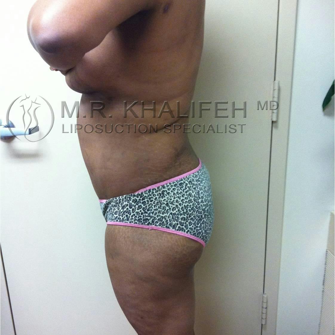 Flank-Lower Back Liposuction Gallery - Patient 3719930 - Image 4