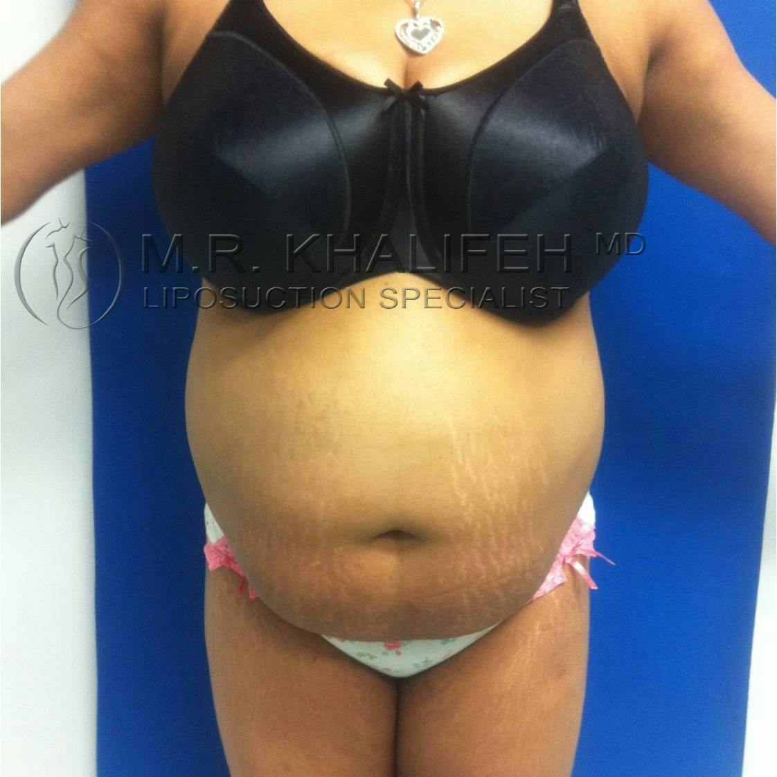 Flank-Lower Back Liposuction Gallery - Patient 3719930 - Image 5