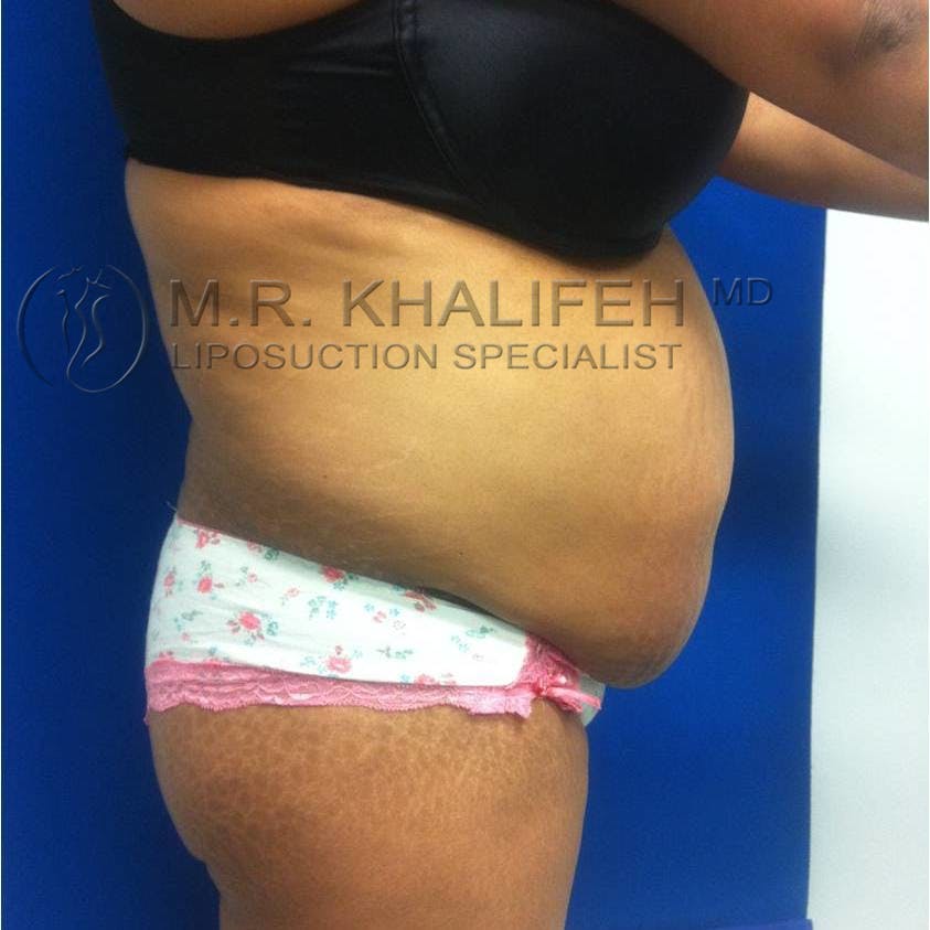 Flank-Lower Back Liposuction Gallery - Patient 3719930 - Image 7