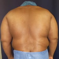 Flank-Lower Back Liposuction Gallery - Patient 3719960 - Image 1