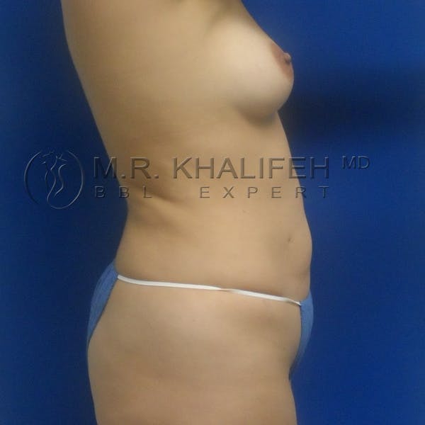 Flank-Lower Back Liposuction Gallery - Patient 3720010 - Image 5