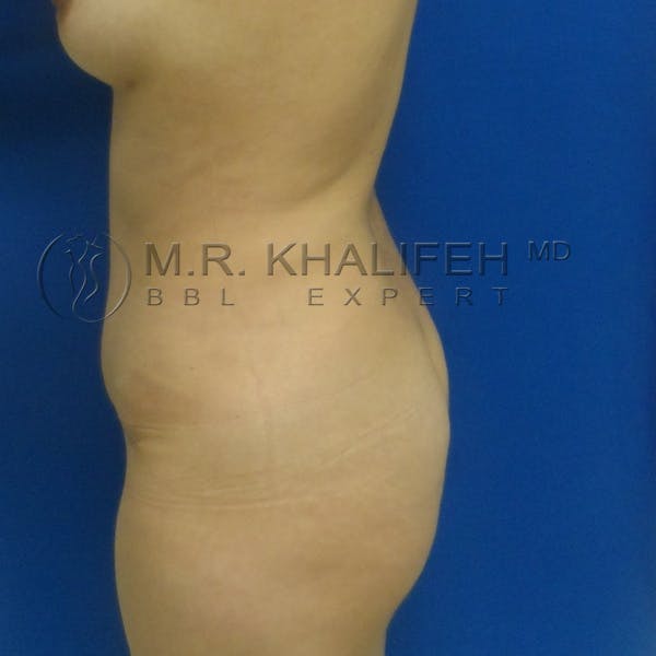 Flank-Lower Back Liposuction Gallery - Patient 3720010 - Image 9