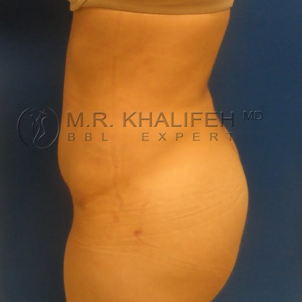 Flank-Lower Back Liposuction Gallery - Patient 3720010 - Image 10