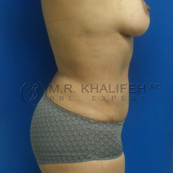 Flank-Lower Back Liposuction Gallery - Patient 3720074 - Image 10