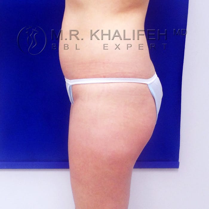 Flank-Lower Back Liposuction Gallery - Patient 3720139 - Image 9