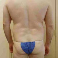 Flank-Lower Back Liposuction Gallery - Patient 3720278 - Image 1