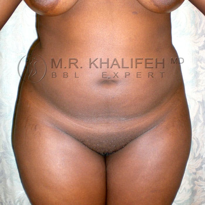 Flank-Lower Back Liposuction Gallery - Patient 3720334 - Image 1