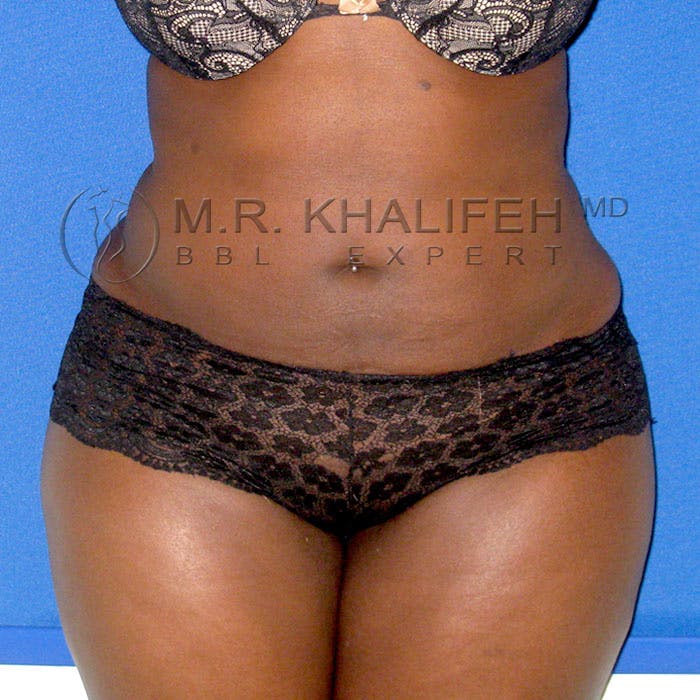 Flank-Lower Back Liposuction Gallery - Patient 3720334 - Image 2