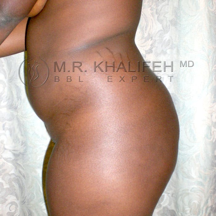 Flank-Lower Back Liposuction Gallery - Patient 3720334 - Image 5